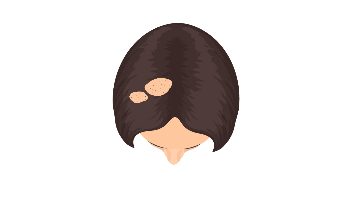 Top view showing circular bald patches