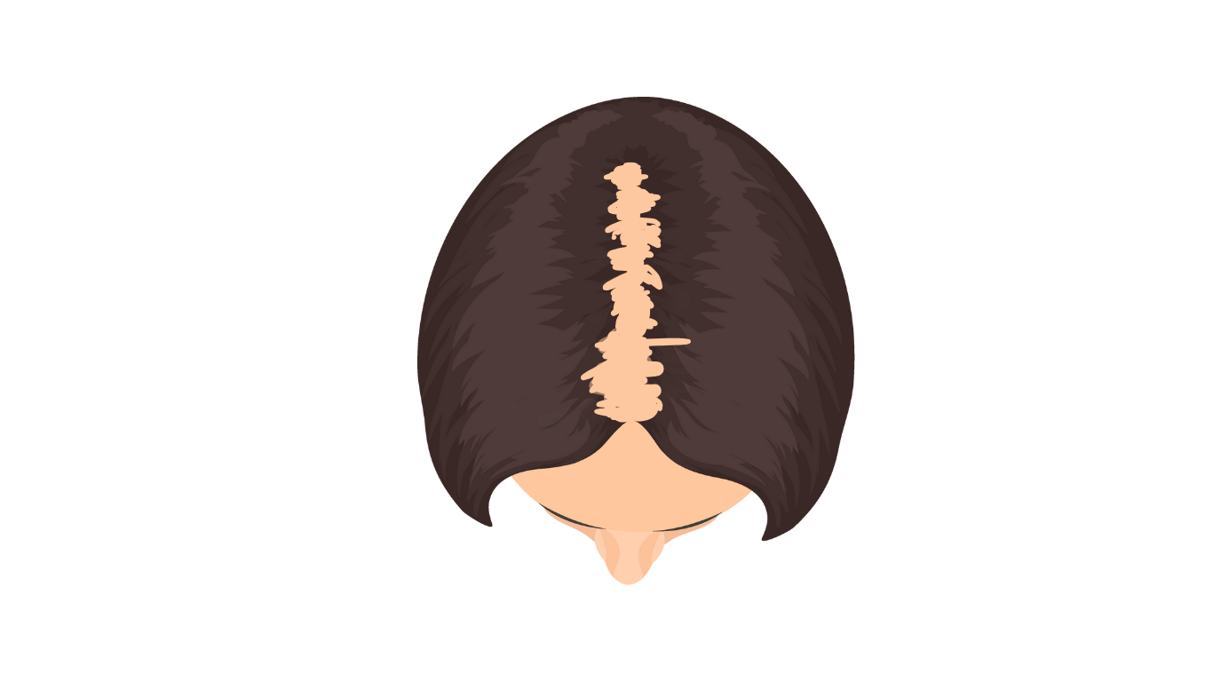 Top view showing central part thinning